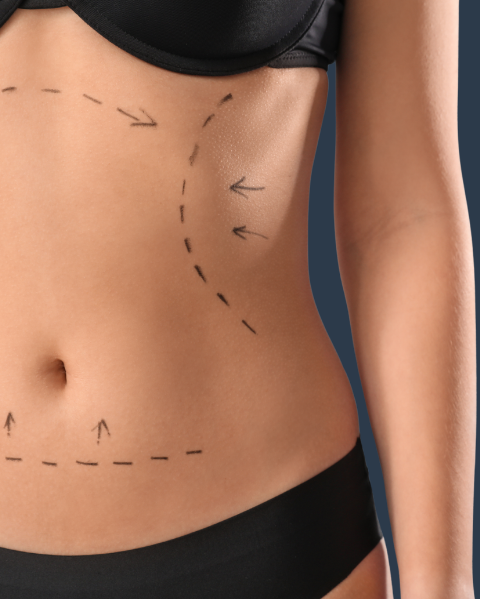 Belt Lipectomy surgery The Mere Hospital Cheshire Northwest